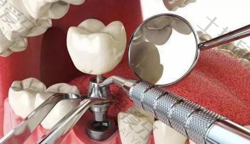 种植牙半口有几种方法