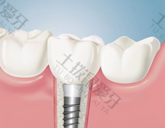 镶牙和种牙有什么区别哪个好 种植牙和镶牙的区别