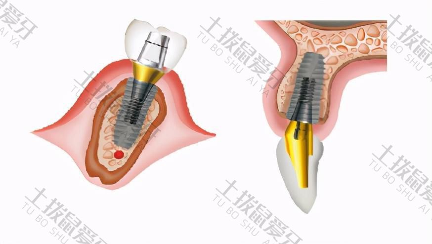 登腾种植牙后期稳定性怎么样