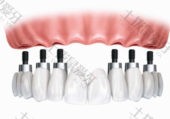 全口种植牙费用一般在多少钱