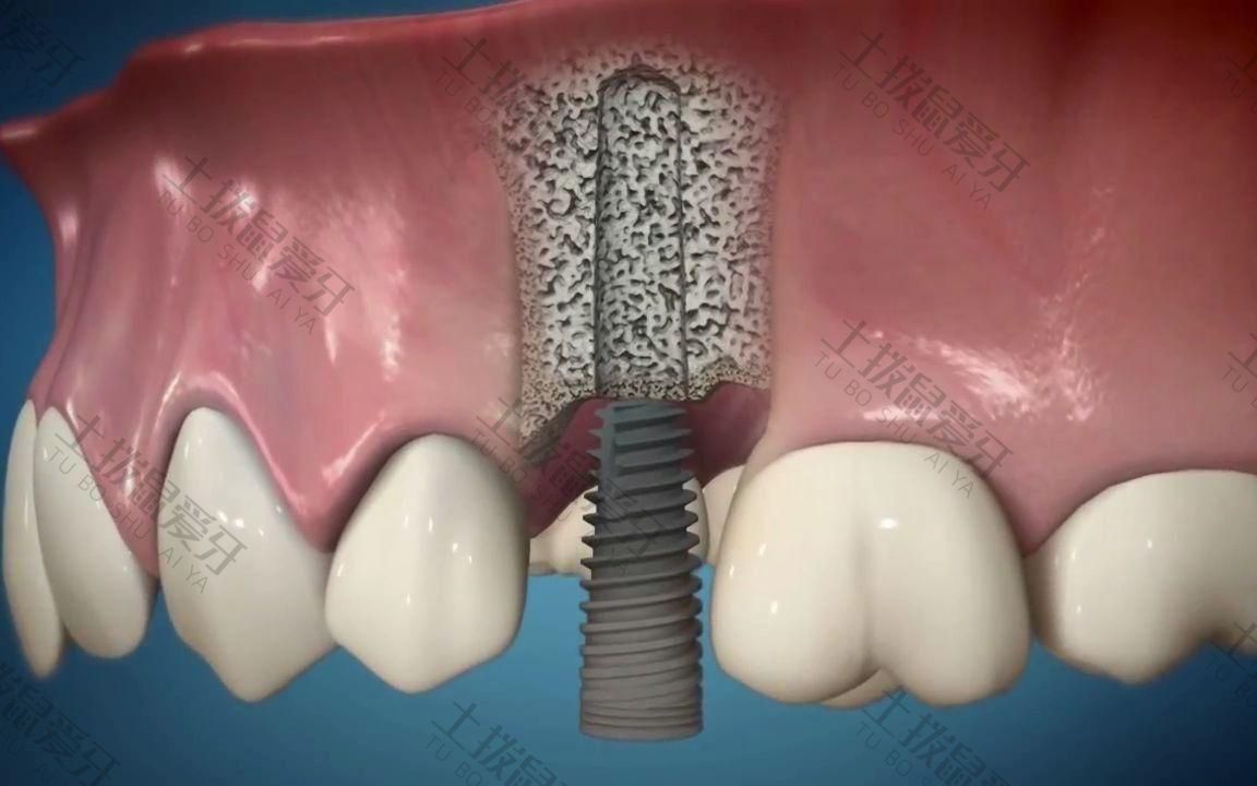 种植牙二期手术过程图片