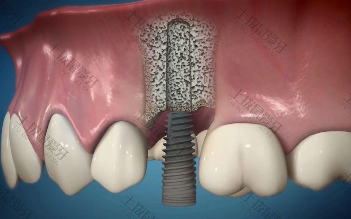 种植牙二期手术过程