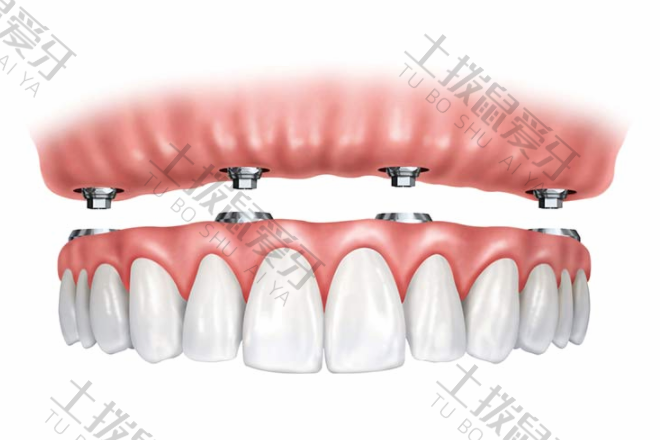 全口种植牙的新技术