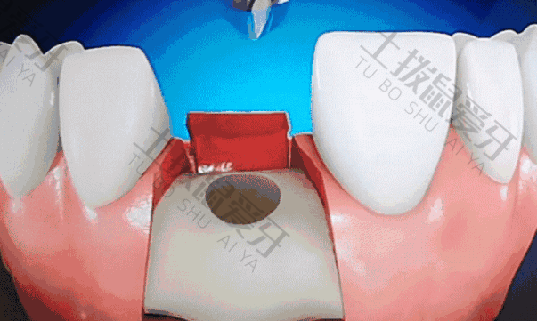 种植牙手术有风险吗