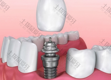 种植牙手术费明细 种植牙手术费和材料费能用医保
