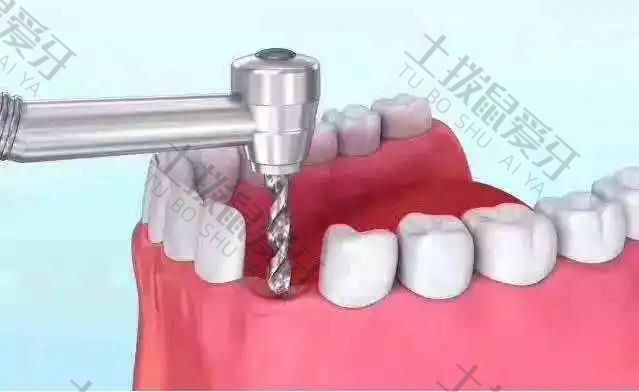 种植牙第二期手术
