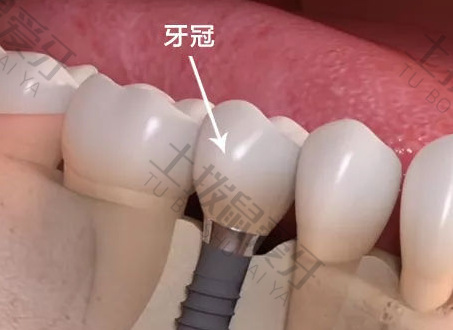 种植牙二期手术疼多久 种牙第二期安装基台要缝针吗