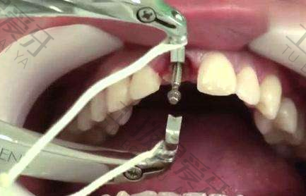 种植牙手术后会痛多久