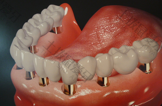 种植牙二期手术要恢复多久