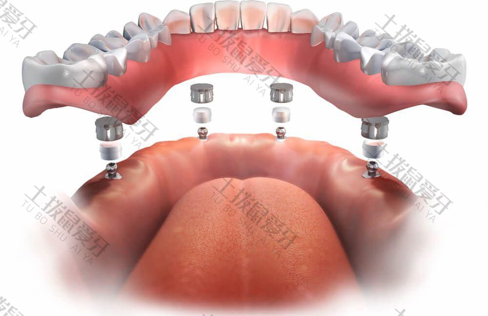 种植牙二期手术要恢复多久