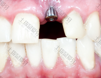 种植牙手术流程 种植牙手术要做多久