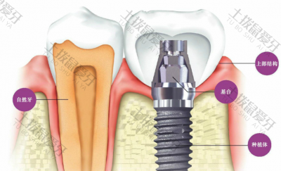 种植牙手术后多久可以正常吃东西 种植牙手术后多久消肿