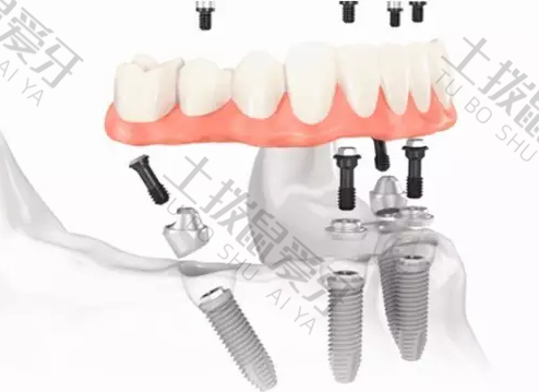 满口种植牙价钱