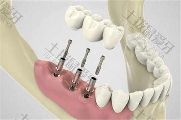 下门牙种植牙多少钱