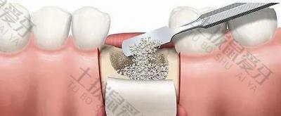 满口牙齿种植过程 种植牙的全过程大概多长时间
