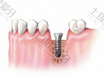 门牙能种植牙吗 种植牙门牙多少钱一颗