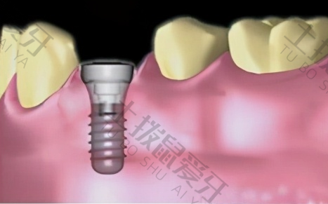 微创种植牙的步骤