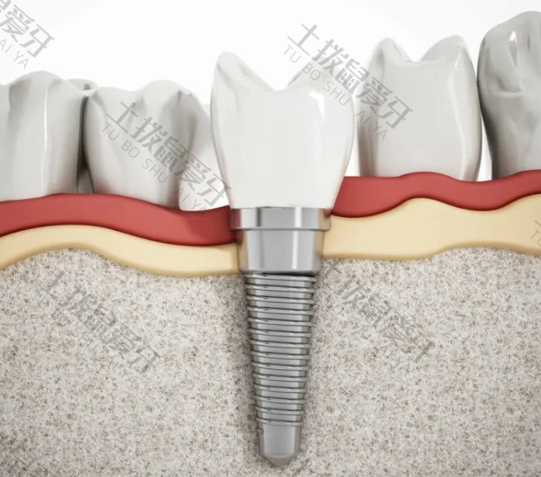 种植牙植入骨粉成功率高吗