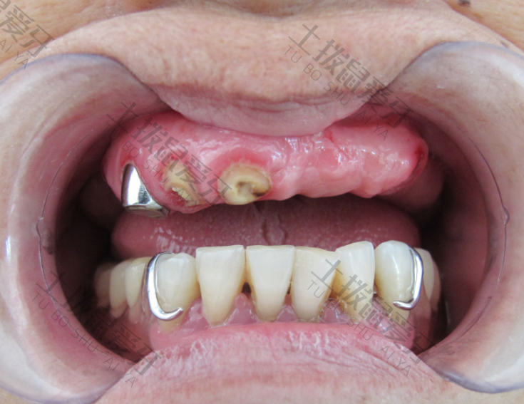 微创种植牙过程