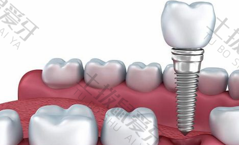 国产种植牙怎么样