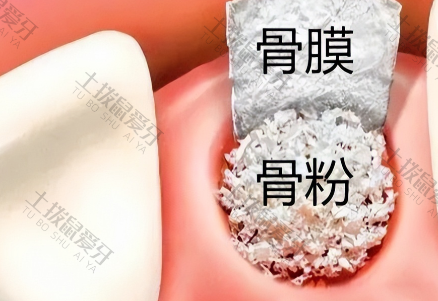 4000元的种植牙可靠吗