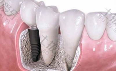 种植牙手术的过程 口腔种植牙价格多少