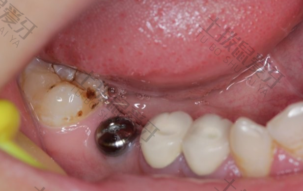 无痛微创种植牙与普通种植牙的不同