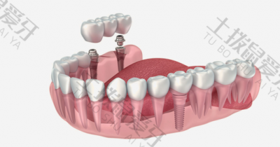瑞士种植牙品牌有几种 瑞士品牌种植牙哪个最好