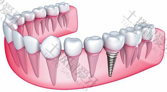 种植牙后要注意什么