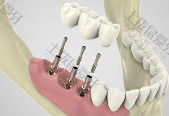 老人种植全口牙费用