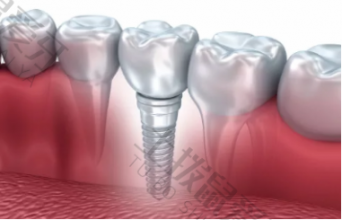 老人种植牙齿多少钱 老人缺牙种植的注意事项是什么