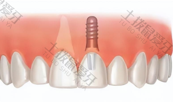 门牙种植牙过程痛
