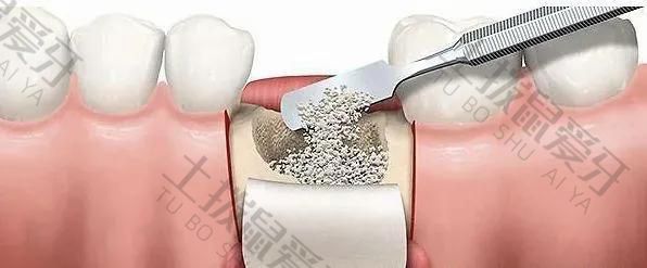 种牙填骨粉后遗症