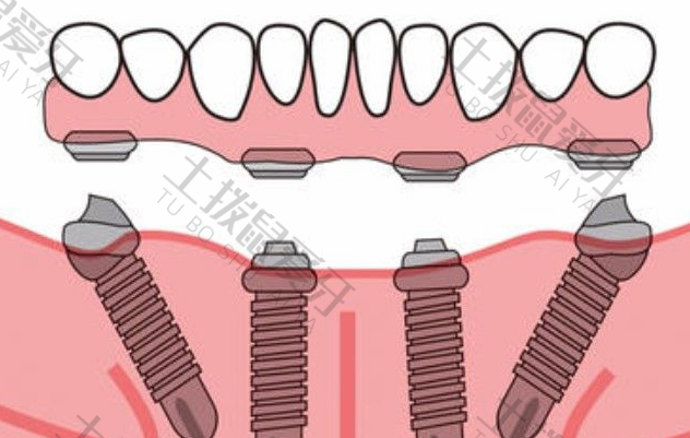 在种植牙过程中为什么要用骨粉和骨膜