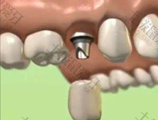 牙槽骨吸收还能种牙吗