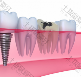种牙填骨粉疼吗 种植牙植入骨粉成功率