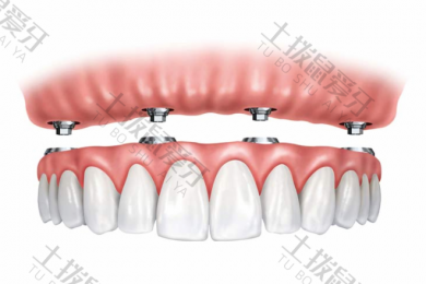 牙槽骨吸收还能种牙吗 种植牙植入骨粉注意事项
