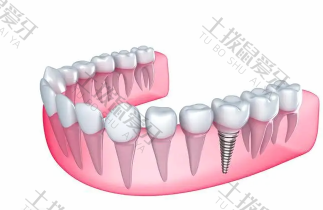 国产种植牙品牌有哪些