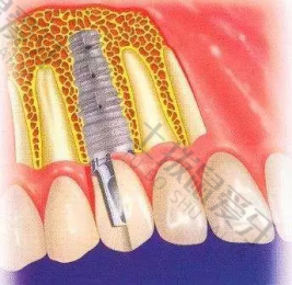 种植牙手术需要多少钱费用 种植牙手术需要多长时间