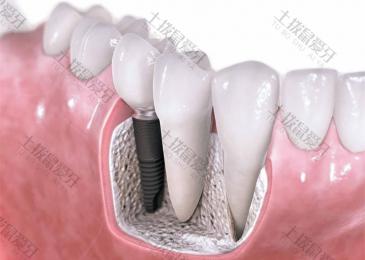 种植牙分几期才可以完成 种植牙二期手术怎么做