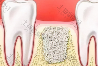 种植牙基台是什么材料 种植牙二期上基台疼吗