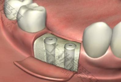 种植牙费用明细