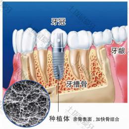 门牙种植牙最快多久可以完成 种植牙的费用可以用医保来报销吗