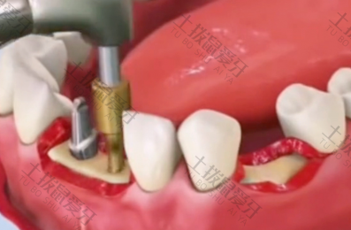 种植牙安装牙冠后注意事项 种植牙装牙冠过程疼吗