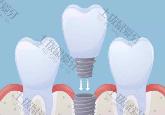 门牙种植牙需要多少钱一颗