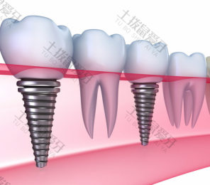 微创种植牙和普通种植牙区别 微创种植牙的过程步骤