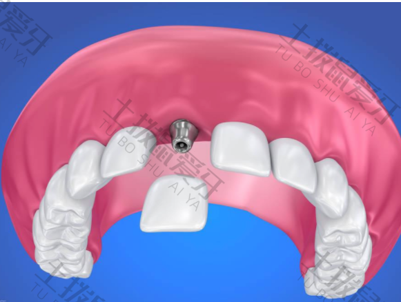 种植牙手术流程