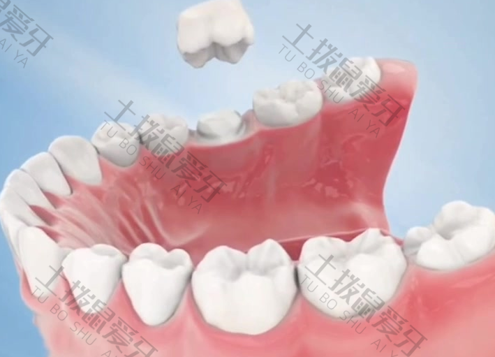 微创种植牙的前提条件是什么