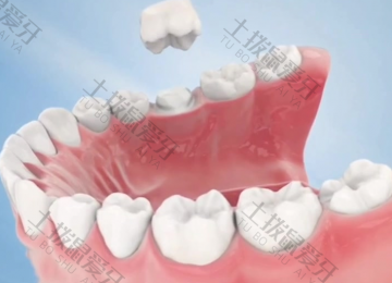 微创种植牙的前提条件是什么 种植牙可以即拔即种吗
