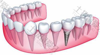 种牙拆线最晚不能超过多少天 种植牙一期拆线后金属露出来怎么办